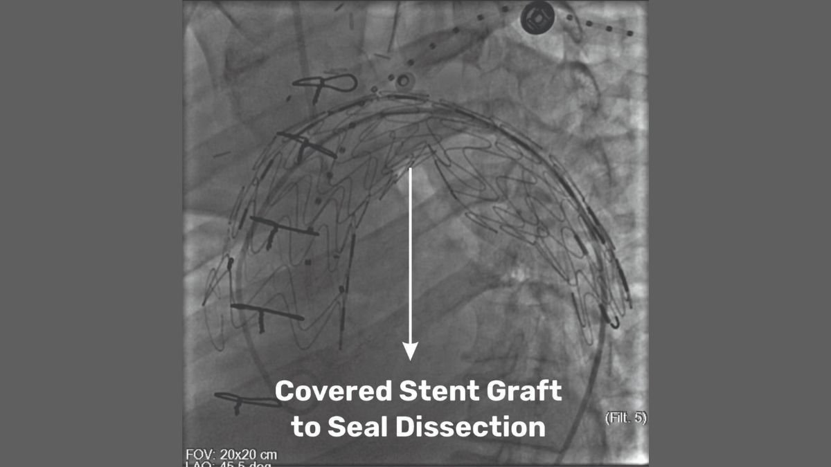 Medical Marvel at SSB Heart and Multispeciality Hospital: Pioneering Hybrid Procedure Saves a Life